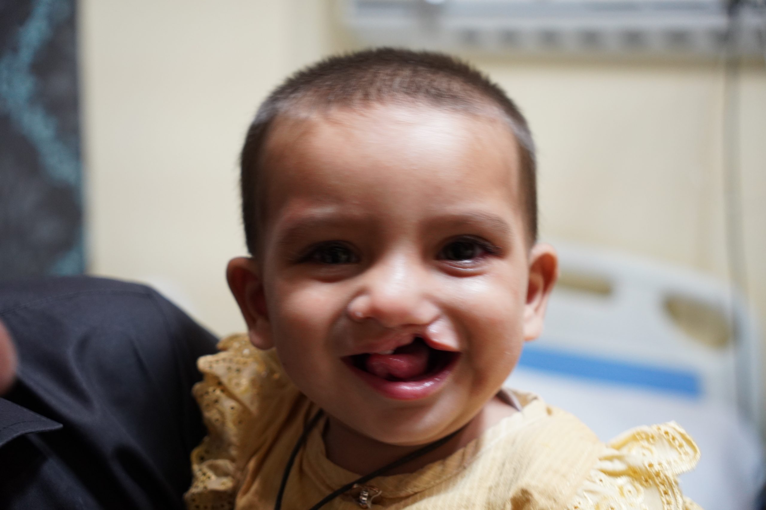 Cleft Lip Surgery